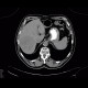 Hepatocellular adenoma, bleeding after biopsy: CT - Computed tomography